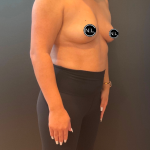 Breast Augmentation Before & After Patient #16310