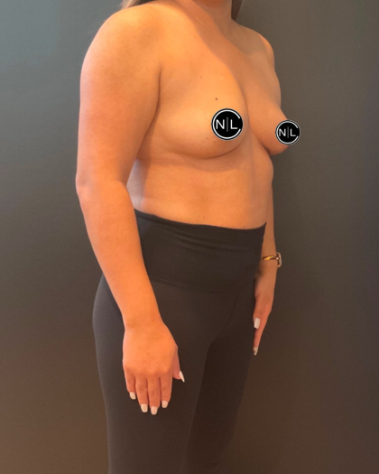 Breast Augmentation Before & After Patient #16310