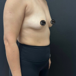 Breast Augmentation Before & After Patient #16331