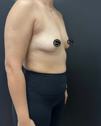 Breast Augmentation Before & After Patient #16331