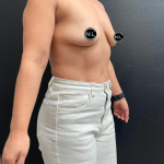 Breast Augmentation Before & After Patient #16309