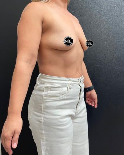 Breast Augmentation Before & After Patient #16309
