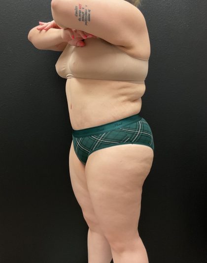 Abdominoplasty Before & After Patient #16332