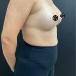 Breast Augmentation Before & After Patient #16331