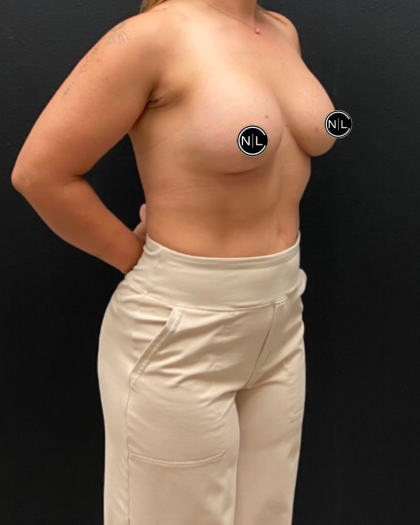Breast Augmentation Before & After Patient #16309