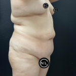 Abdominoplasty Before & After Patient #16332
