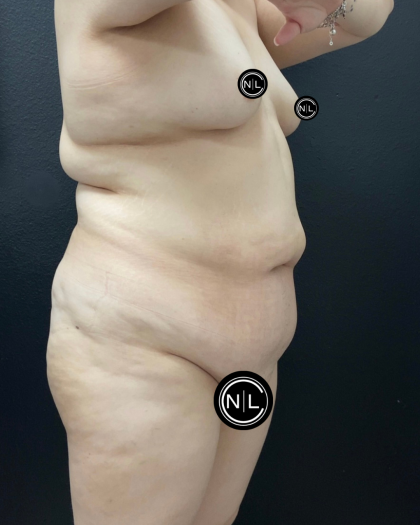 Abdominoplasty Before & After Patient #16332