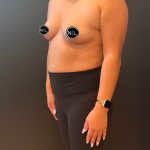 Breast Augmentation Before & After Patient #16310