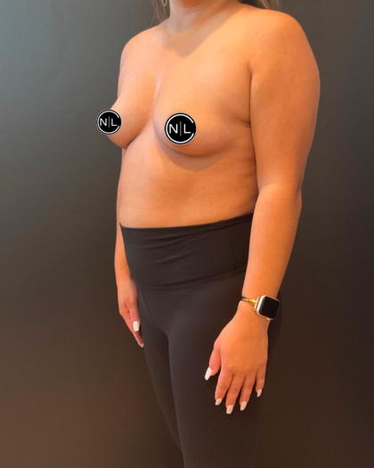 Breast Augmentation Before & After Patient #16310