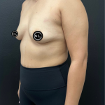 Breast Augmentation Before & After Patient #16331
