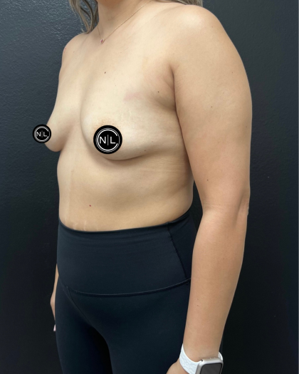 Breast Augmentation Before & After Patient #16331