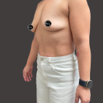 Breast Augmentation Before & After Patient #16309