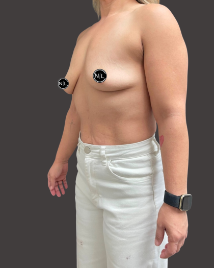 Breast Augmentation Before & After Patient #16309
