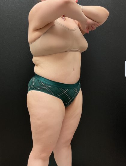 Abdominoplasty Before & After Patient #16332