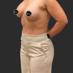 Breast Augmentation Before & After Patient #16309