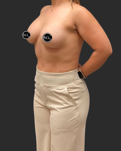 Breast Augmentation Before & After Patient #16309