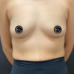 Breast Augmentation Before & After Patient #16331