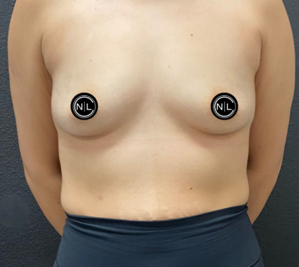 Breast Augmentation Before & After Patient #16331