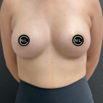 Breast Augmentation Before & After Patient #16331
