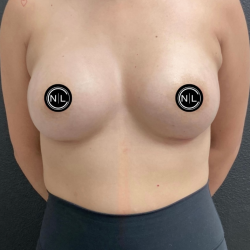 Breast Augmentation Before & After Patient #16331