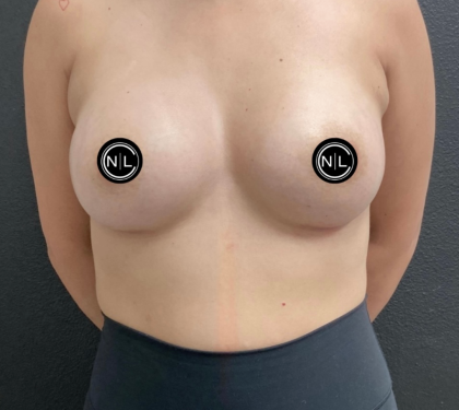 Breast Augmentation Before & After Patient #16331