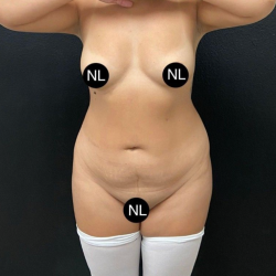 Abdominoplasty Before & After Patient #16428