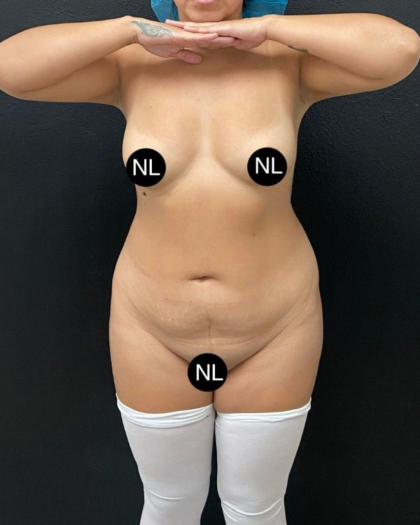 Abdominoplasty Before & After Patient #16428