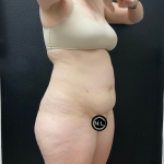 Abdominoplasty Before & After Patient #16429