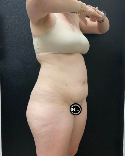 Abdominoplasty Before & After Patient #16429