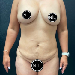 Mommy Makeover Before & After Patient #16426