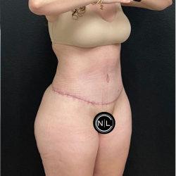 Abdominoplasty Before & After Patient #16429