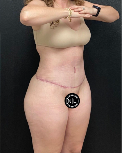 Abdominoplasty Before & After Patient #16429