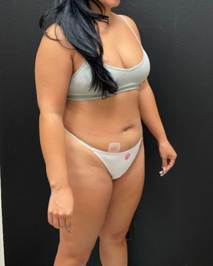 Abdominoplasty Before & After Patient #16428