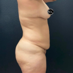 Mommy Makeover Before & After Patient #16426