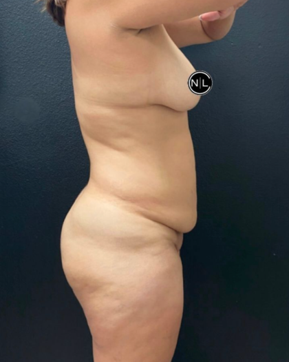 Mommy Makeover Before & After Patient #16426