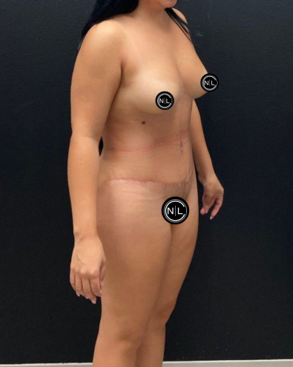 Abdominoplasty Before & After Patient #16428