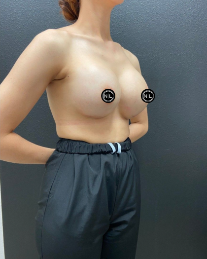 Breast Augmentation Before & After Patient #16427
