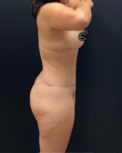 Mommy Makeover Before & After Patient #16426