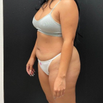 Abdominoplasty Before & After Patient #16428