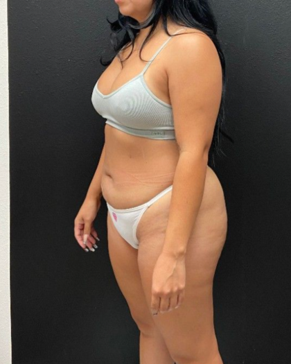 Abdominoplasty Before & After Patient #16428