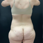 Abdominoplasty Before & After Patient #16429