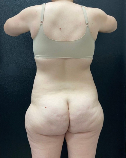 Abdominoplasty Before & After Patient #16429