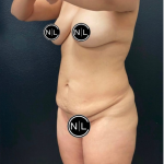 Mommy Makeover Before & After Patient #16426