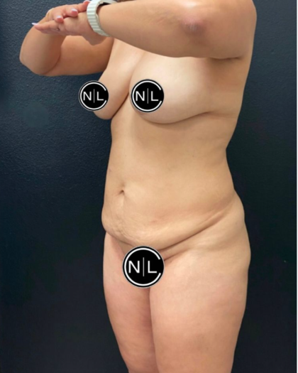 Mommy Makeover Before & After Patient #16426