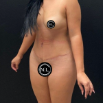 Abdominoplasty Before & After Patient #16428