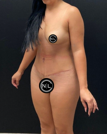 Abdominoplasty Before & After Patient #16428