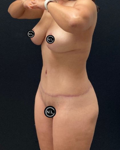 Mommy Makeover Before & After Patient #16426