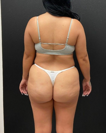 Abdominoplasty Before & After Patient #16428