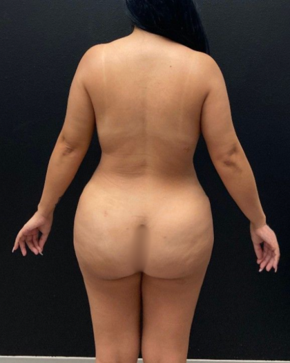 Abdominoplasty Before & After Patient #16428