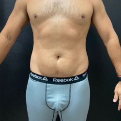 Liposuction Before & After Patient #16500